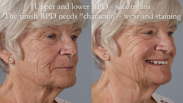 Eileen's transformation with upper and lower RPDs of Scandinavian hygienic design FULL PROTOCOL