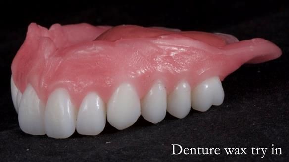 Newsletter 65 Marisa Provision of Complete Dentures on badly placed implants