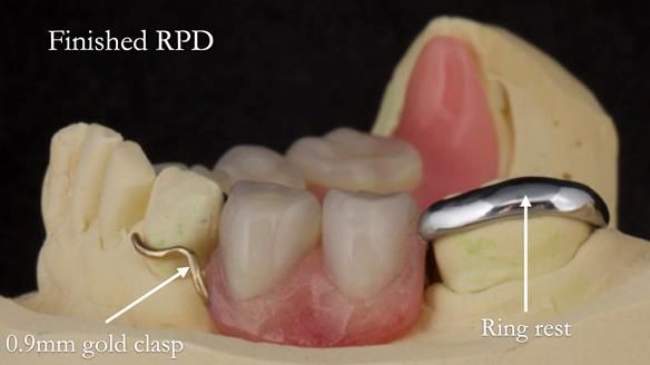 Eileen's transformation with upper and lower RPDs of Scandinavian hygienic design FULL PROTOCOL