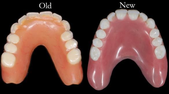 Newsletter 65 Marisa Provision of Complete Dentures on badly placed implants