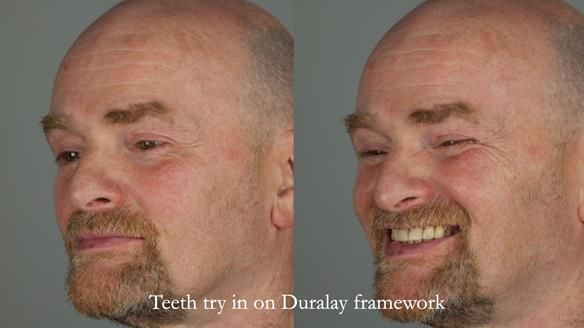 How Keith’s combat denture transformed his life – Newsletter 73