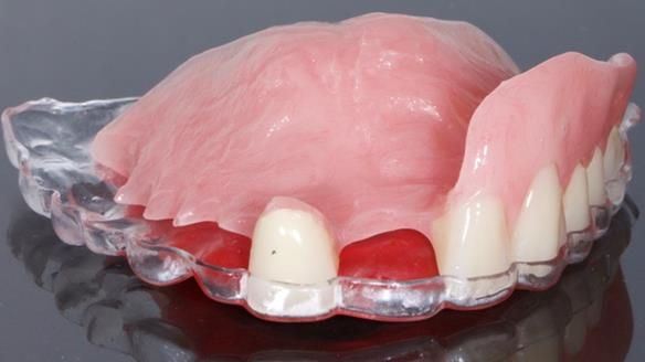 Newsletter 44 - extreme removable prosthodontics – engineering a super-strong and ultra-thin over denture