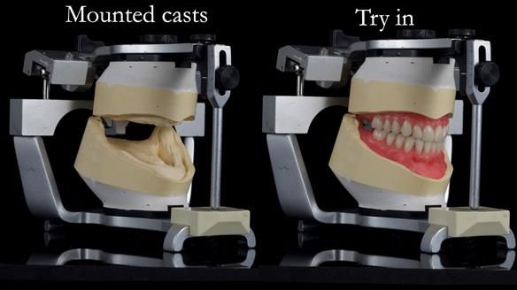 Newsletter 68 Restoring Jan’s Smile: Complete Dentures Inspired by Her Daughter’s Teeth - Post Mouth Surgery