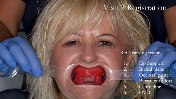 Newsletter 68 Restoring Jan’s Smile: Complete Dentures Inspired by Her Daughter’s Teeth - Post Mouth Surgery