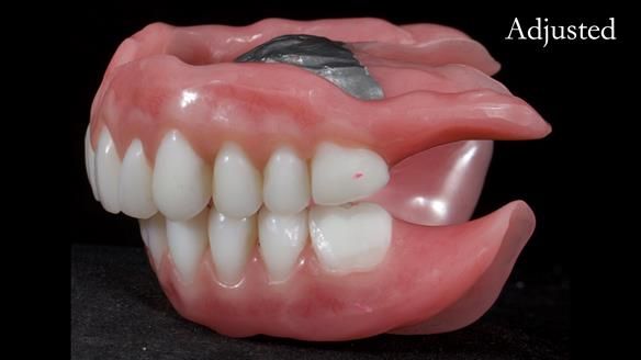 Newsletter 65 Marisa Provision of Complete Dentures on badly placed implants