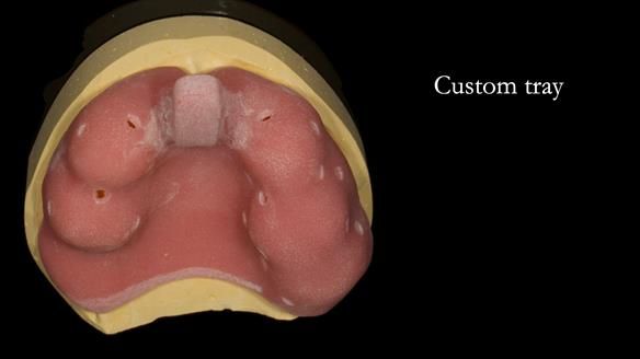 Newsletter 71 Jean’s Class I Mod III RPD: See my mistakes Fractured Mk1 to a Stronger Mk2 RPD (4 years on)