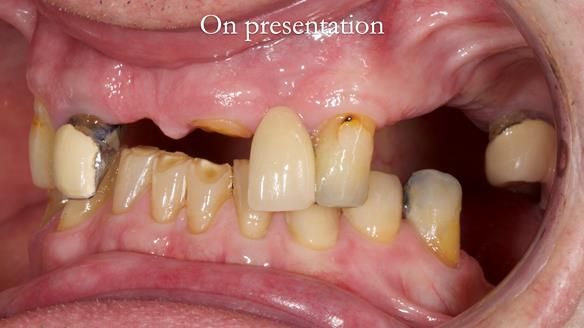 Managing Edgar “THE SCEPTIC” with an RPD/Splint FULL CASE