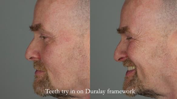 How Keith’s combat denture transformed his life – Newsletter 73