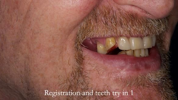 How Keith’s combat denture transformed his life – Newsletter 73