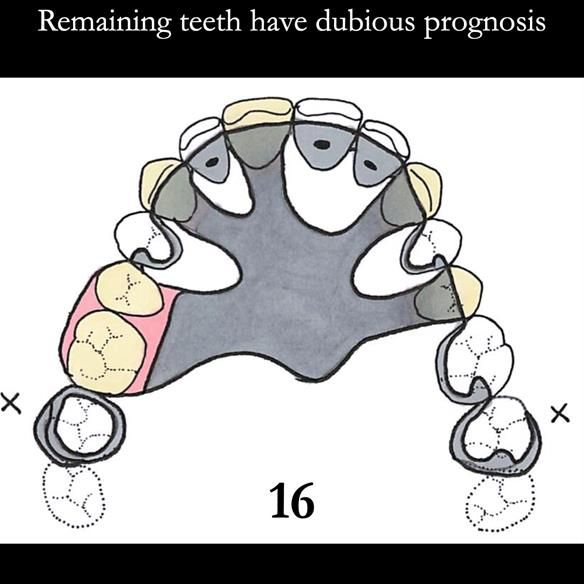 Universal Scandinavian partial denture designs