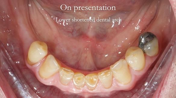 Managing Edgar “THE SCEPTIC” with an RPD/Splint FULL CASE