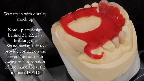 Read Newsletter 67 - Brian's COMBAT DENTURE Case Study