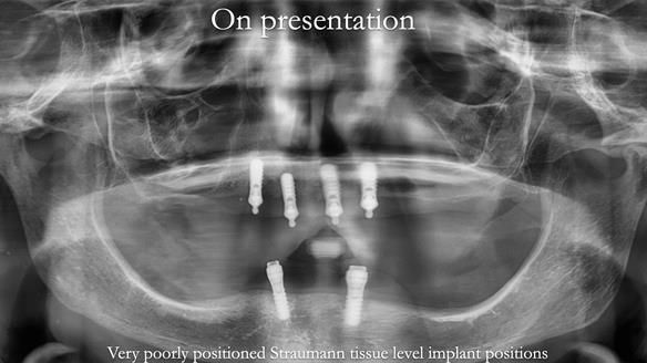 Newsletter 65 Marisa Provision of Complete Dentures on badly placed implants