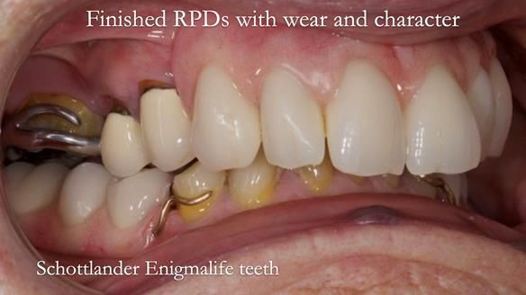 Eileen's transformation with upper and lower RPDs of Scandinavian hygienic design FULL PROTOCOL