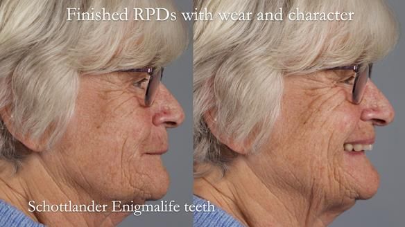 Eileen's transformation with upper and lower RPDs of Scandinavian hygienic design FULL PROTOCOL