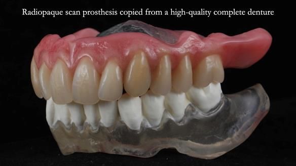 Newsletter 70 Complete Denture Treatment for Kate: A Case Study on Natural-Looking Dentures and Implant-Supported Overdentures