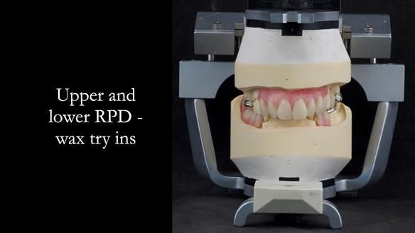 Eileen's transformation with upper and lower RPDs of Scandinavian hygienic design FULL PROTOCOL