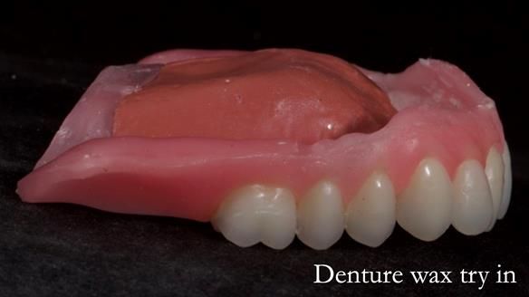 Newsletter 70 Complete Denture Treatment for Kate: A Case Study on Natural-Looking Dentures and Implant-Supported Overdentures