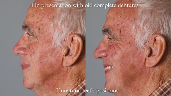 Newsletter 74: Ken’s Case Study Complete Dentures - Life Like and Age Appropriate