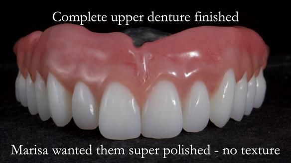 Newsletter 65 Marisa Provision of Complete Dentures on badly placed implants