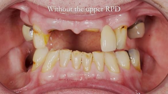 Managing Edgar “THE SCEPTIC” with an RPD/Splint FULL CASE