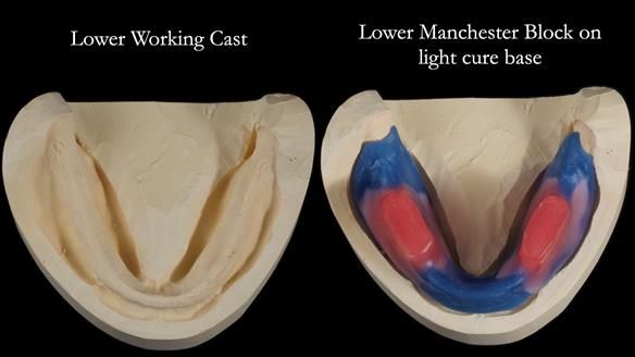 Newsletter 70 Complete Denture Treatment for Kate: A Case Study on Natural-Looking Dentures and Implant-Supported Overdentures