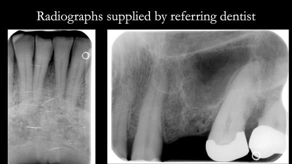 Read Newsletter 67 - Brian's COMBAT DENTURE Case Study