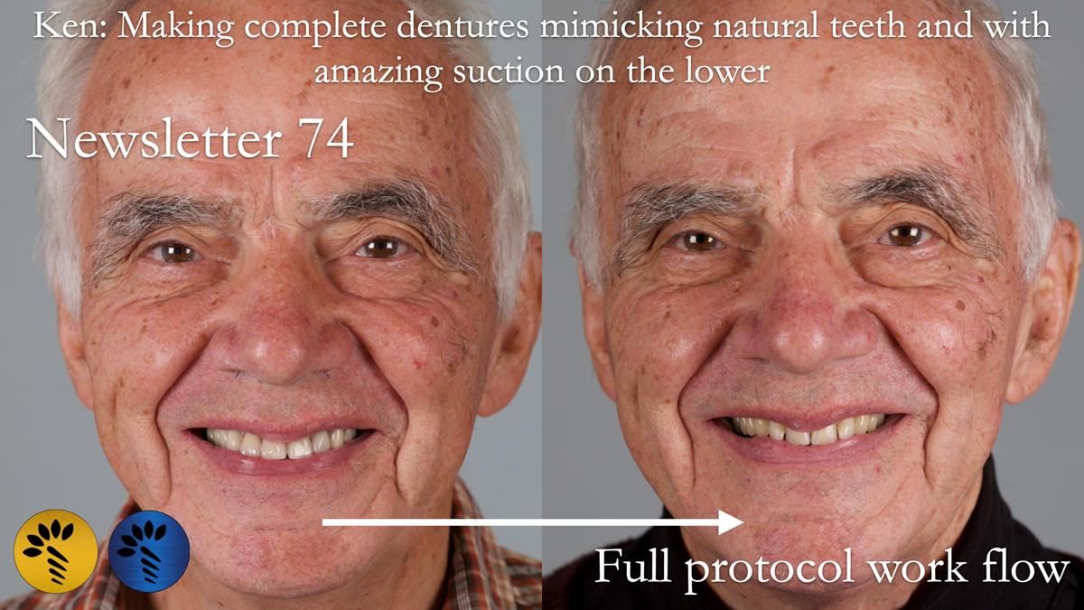 Newsletter 74: Ken’s Case Study Complete Dentures - Life Like and Age Appropriate