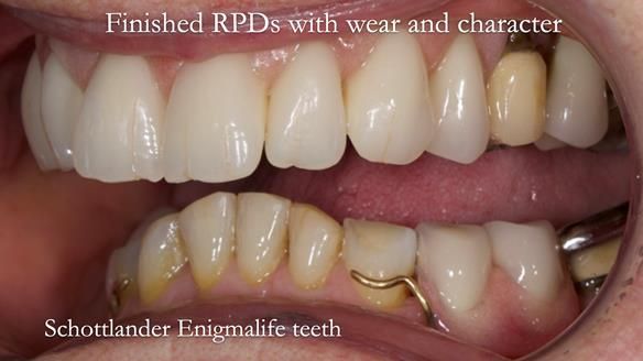 Eileen's transformation with upper and lower RPDs of Scandinavian hygienic design FULL PROTOCOL