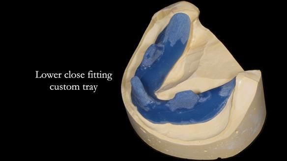 Newsletter 70 Complete Denture Treatment for Kate: A Case Study on Natural-Looking Dentures and Implant-Supported Overdentures