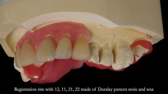 How Keith’s combat denture transformed his life – Newsletter 73