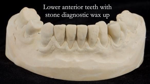 Read Newsletter 67 - Brian's COMBAT DENTURE Case Study