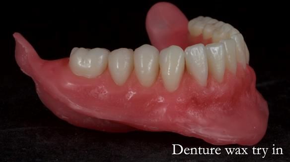 Newsletter 68 Restoring Jan’s Smile: Complete Dentures Inspired by Her Daughter’s Teeth - Post Mouth Surgery