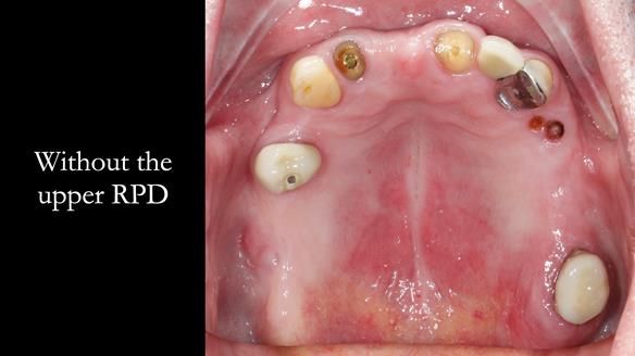 Managing Edgar “THE SCEPTIC” with an RPD/Splint FULL CASE