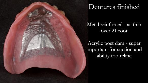 Newsletter 74: Ken’s Case Study Complete Dentures - Life Like and Age Appropriate