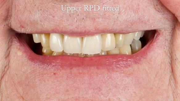 Managing Edgar “THE SCEPTIC” with an RPD/Splint FULL CASE