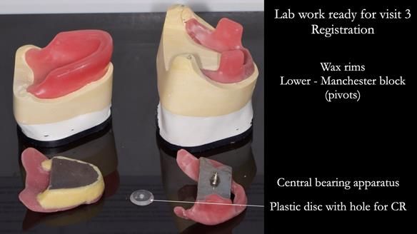 Replacing Madeline’s Complete denture FULL PROTOCOL