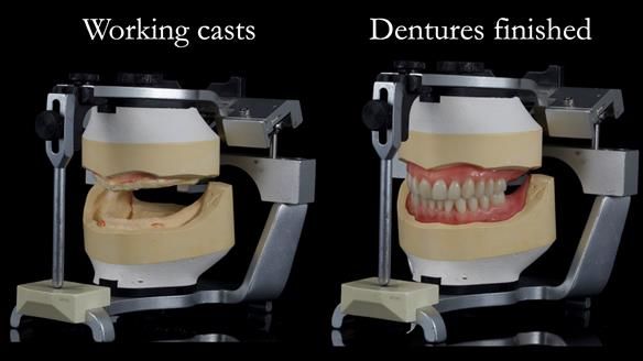 Newsletter 70 Complete Denture Treatment for Kate: A Case Study on Natural-Looking Dentures and Implant-Supported Overdentures