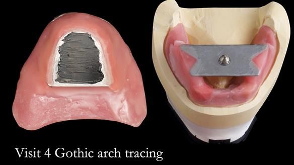 Newsletter 49 Managing Estelle’s failing implants with dentures FULL PROTOCOL