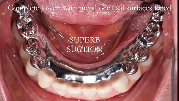 Newsletter 44 - extreme removable prosthodontics – engineering a super-strong and ultra-thin over denture