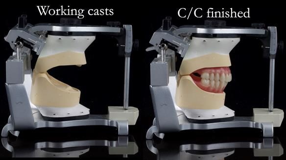 Replacing Madeline’s Complete denture FULL PROTOCOL