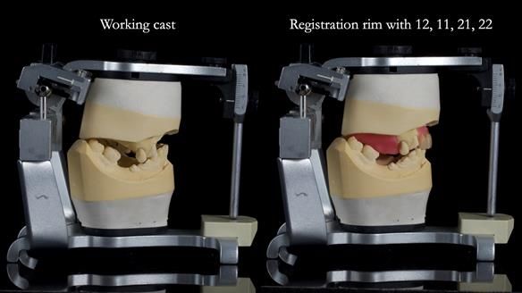 How Keith’s combat denture transformed his life – Newsletter 73