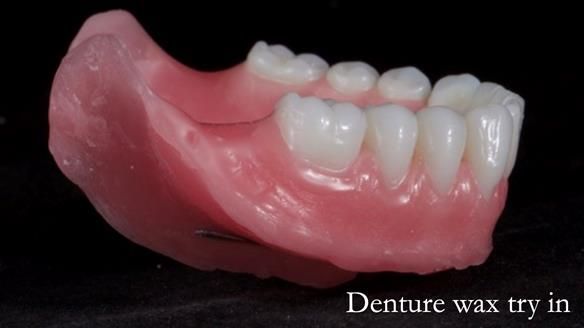 Newsletter 65 Marisa Provision of Complete Dentures on badly placed implants