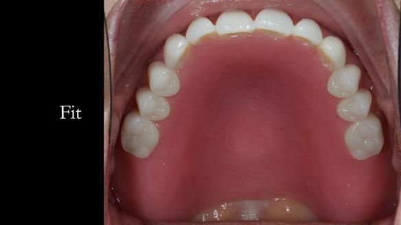 Newsletter 70 Complete Denture Treatment for Kate: A Case Study on Natural-Looking Dentures and Implant-Supported Overdentures