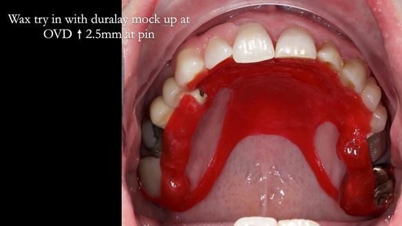 Read Newsletter 67 - Brian's COMBAT DENTURE Case Study