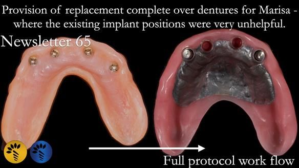 Newsletter 65 Marisa Provision of Complete Dentures on badly placed implants