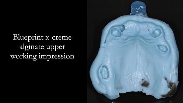 Managing Edgar “THE SCEPTIC” with an RPD/Splint FULL CASE