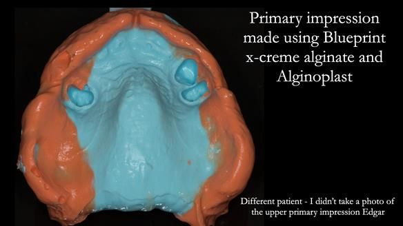 Managing Edgar “THE SCEPTIC” with an RPD/Splint FULL CASE