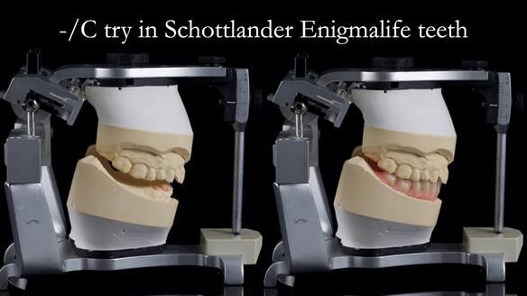 Newsletter 44 - extreme removable prosthodontics – engineering a super-strong and ultra-thin over denture