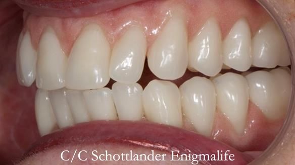 Replacing Madeline’s Complete denture FULL PROTOCOL